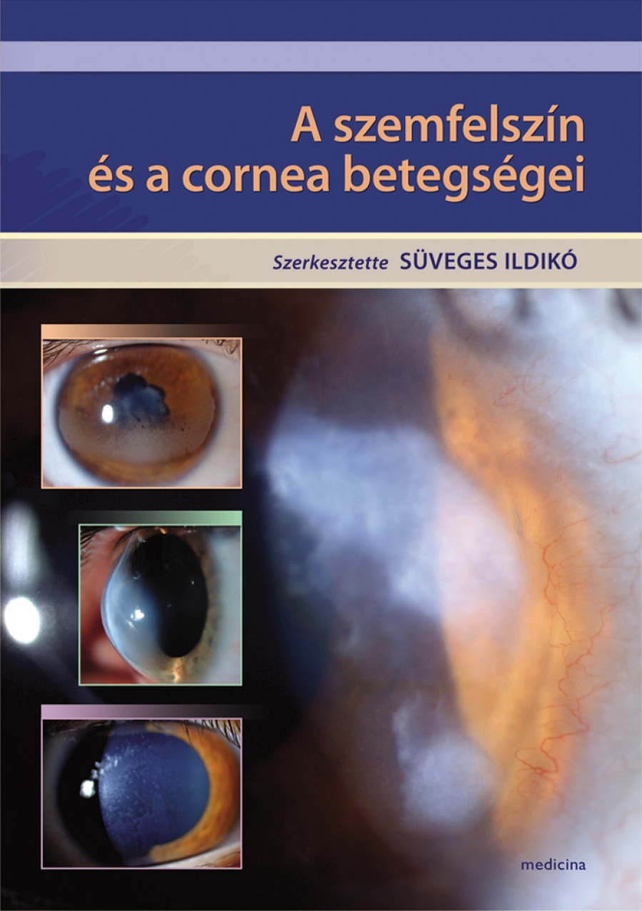 keratitis szemészet látásvizsgálati asztal távolsága